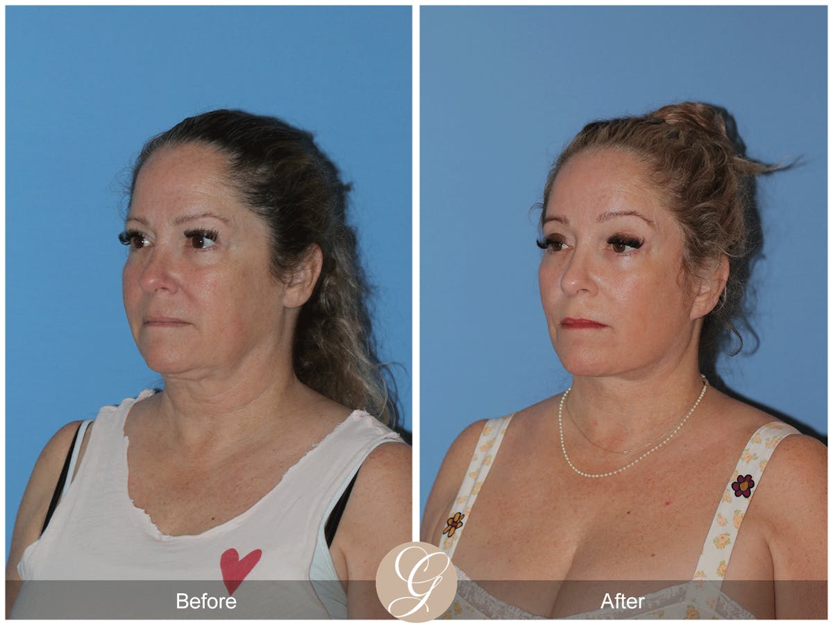 Deep Plane Facelift Before & After Gallery - Patient 226775 - Image 3