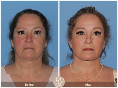 Deep Plane Facelift Before & After Gallery - Patient 226775 - Image 1