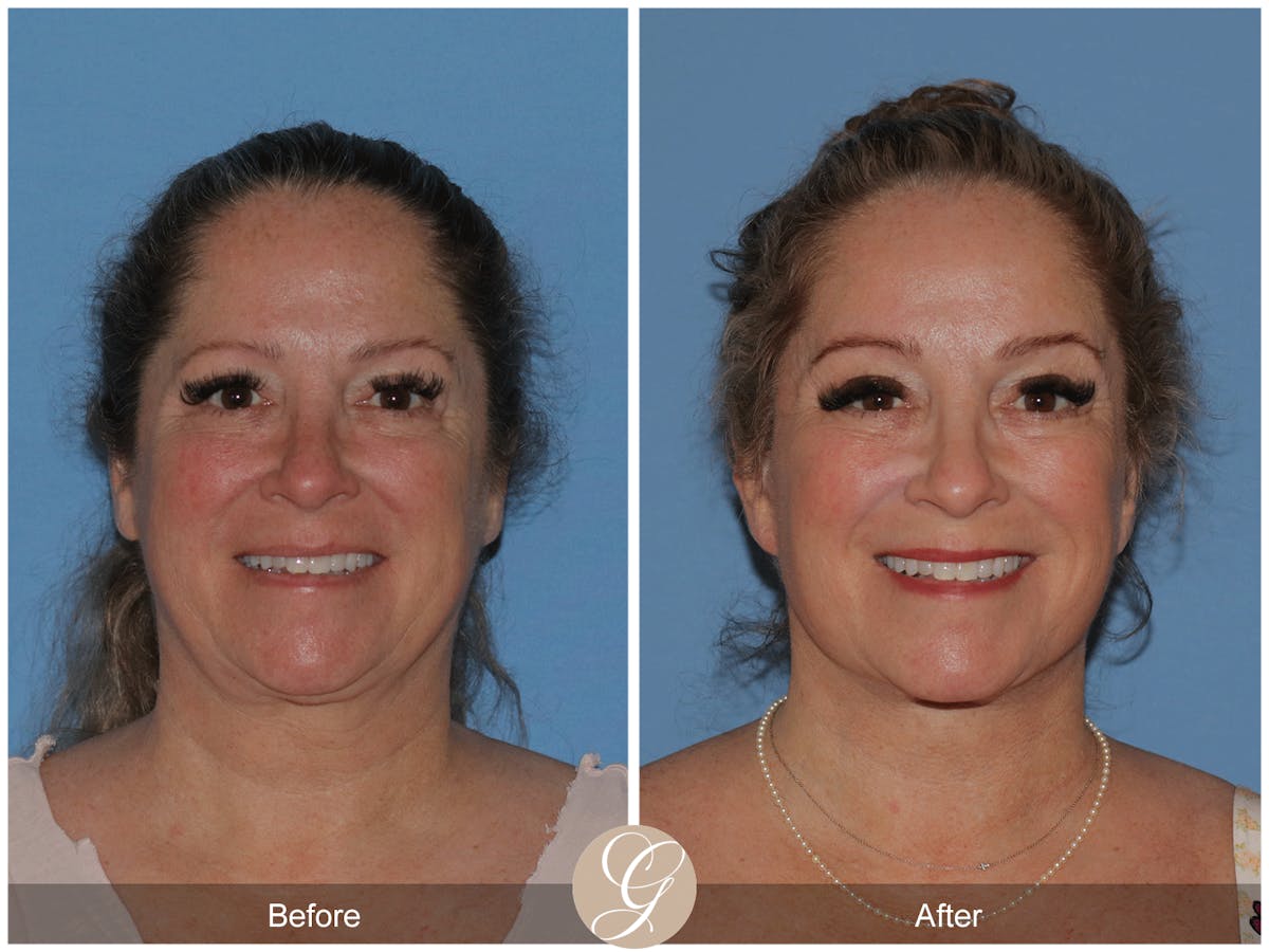 Deep Plane Facelift Before & After Gallery - Patient 226775 - Image 2