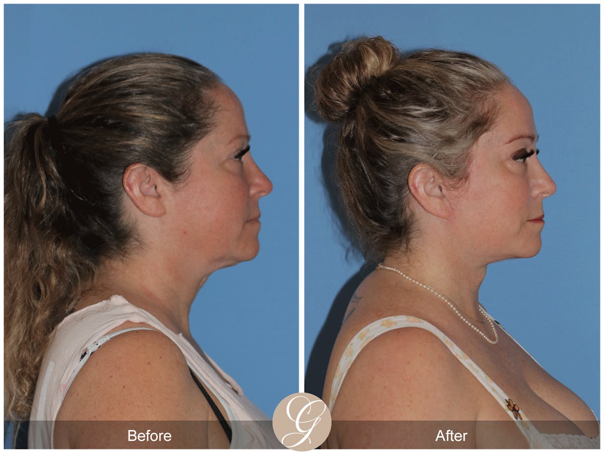 Deep Plane Facelift Before & After Gallery - Patient 226775 - Image 8