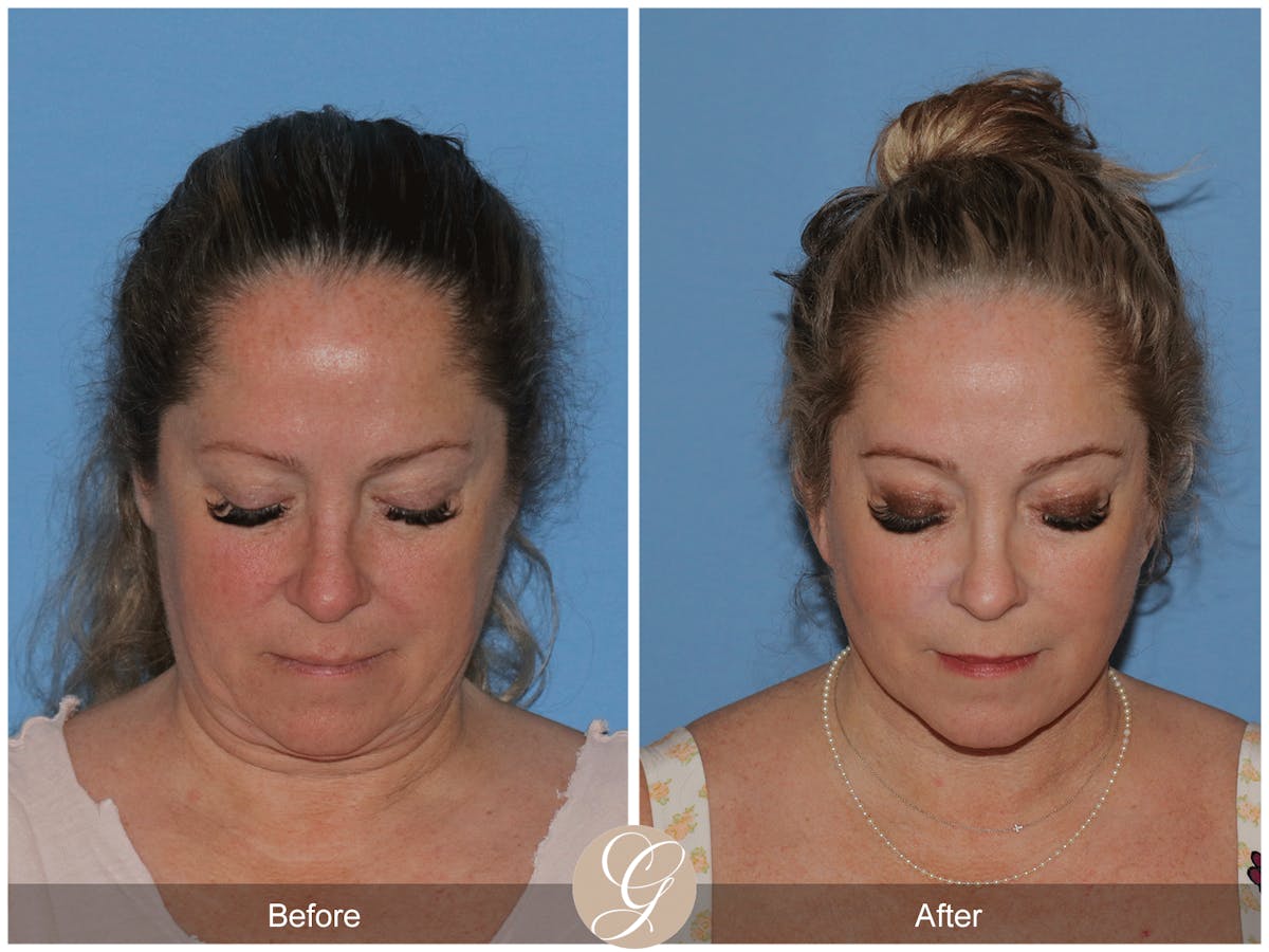 Deep Plane Facelift Before & After Gallery - Patient 226775 - Image 5