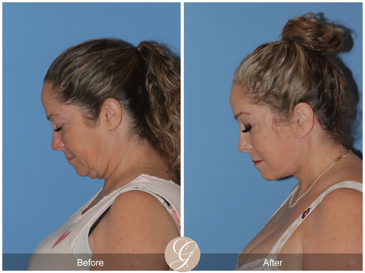 Deep Plane Facelift Before & After Gallery - Patient 226775 - Image 11