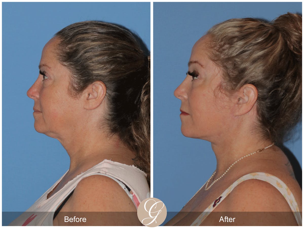 Deep Plane Facelift Before & After Gallery - Patient 226775 - Image 10