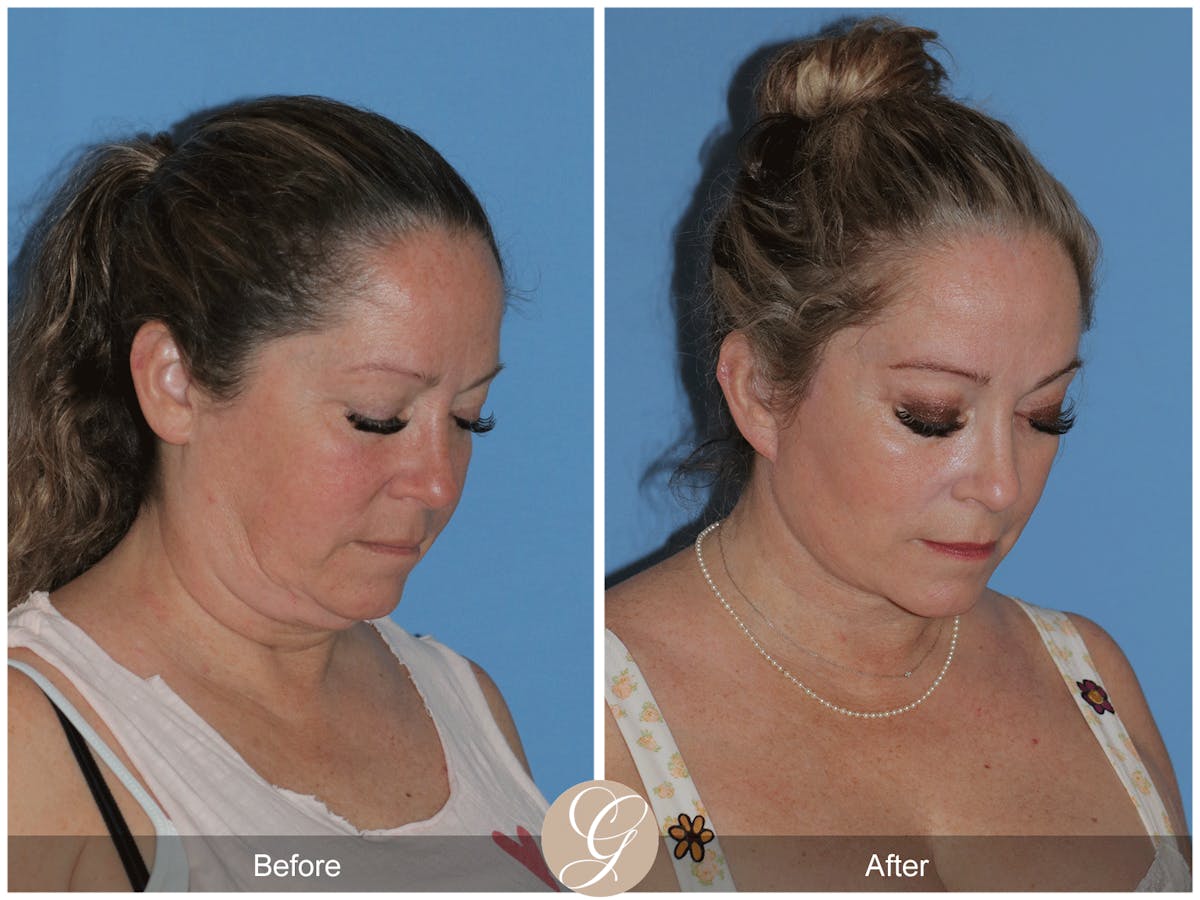 Deep Plane Facelift Before & After Gallery - Patient 226775 - Image 9