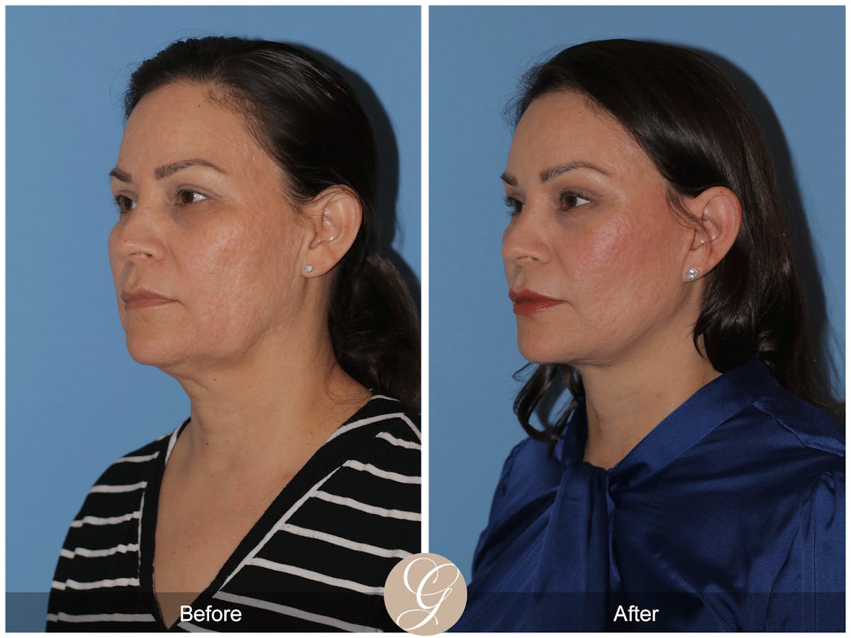 Preservation Facelift Before & After Gallery - Patient 156774 - Image 3