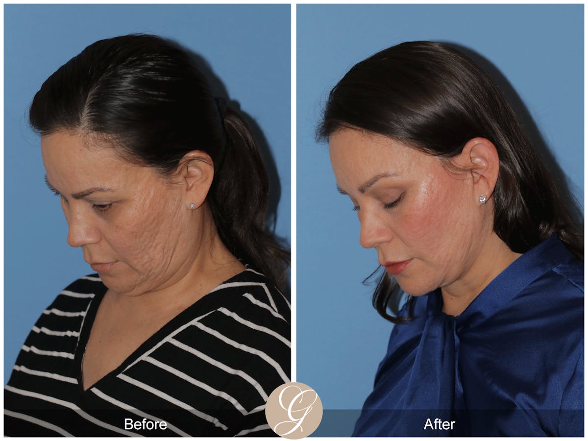 Preservation Facelift Before & After Gallery - Patient 156774 - Image 4