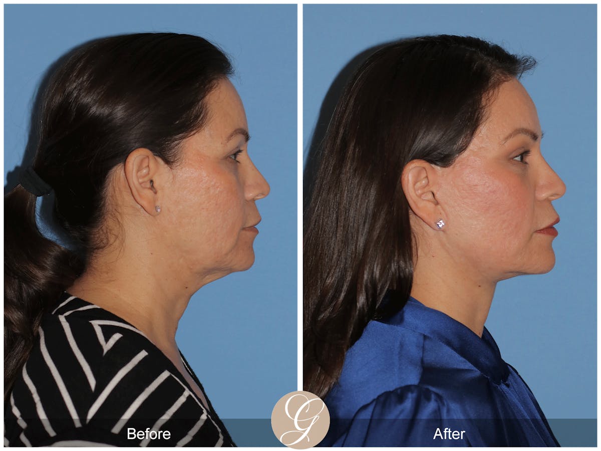 Preservation Facelift Before & After Gallery - Patient 156774 - Image 8
