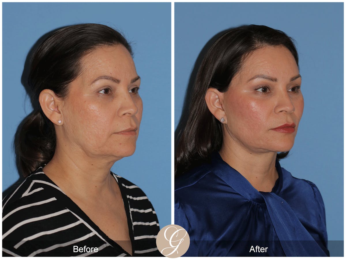Preservation Facelift Before & After Gallery - Patient 156774 - Image 6