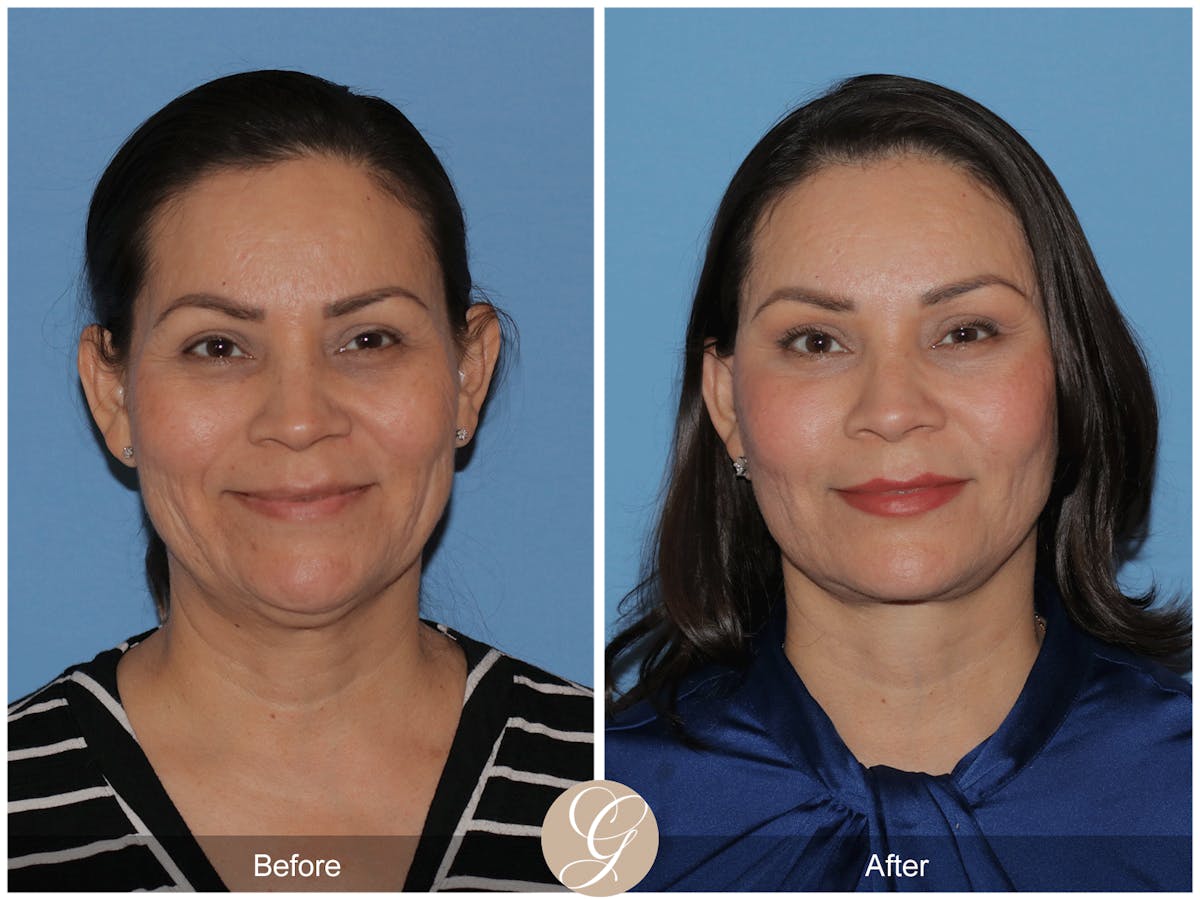 Preservation Facelift Before & After Gallery - Patient 156774 - Image 2