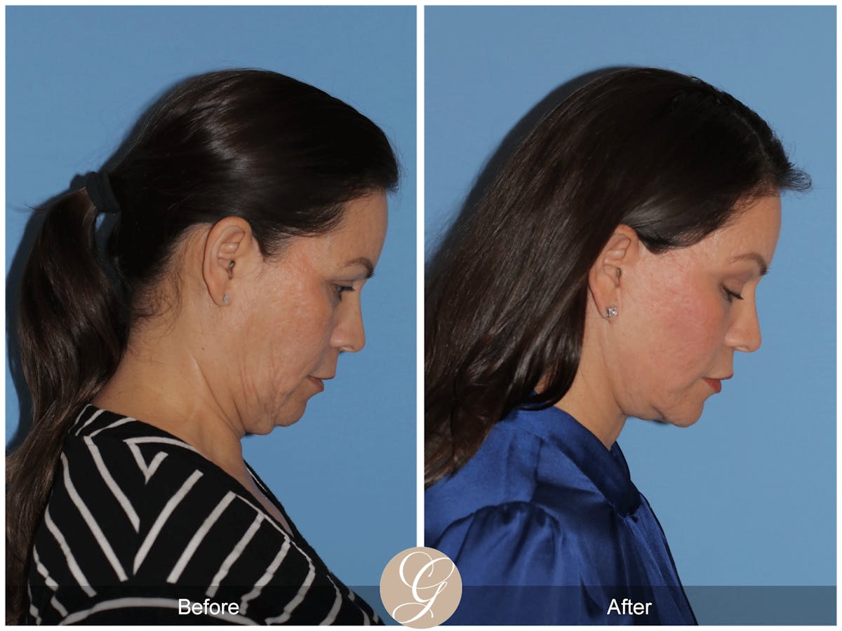 Preservation Facelift Before & After Gallery - Patient 156774 - Image 7