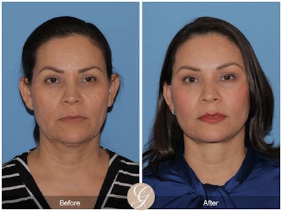 Deep Plane Facelift Before & After Gallery - Patient 401181 - Image 1