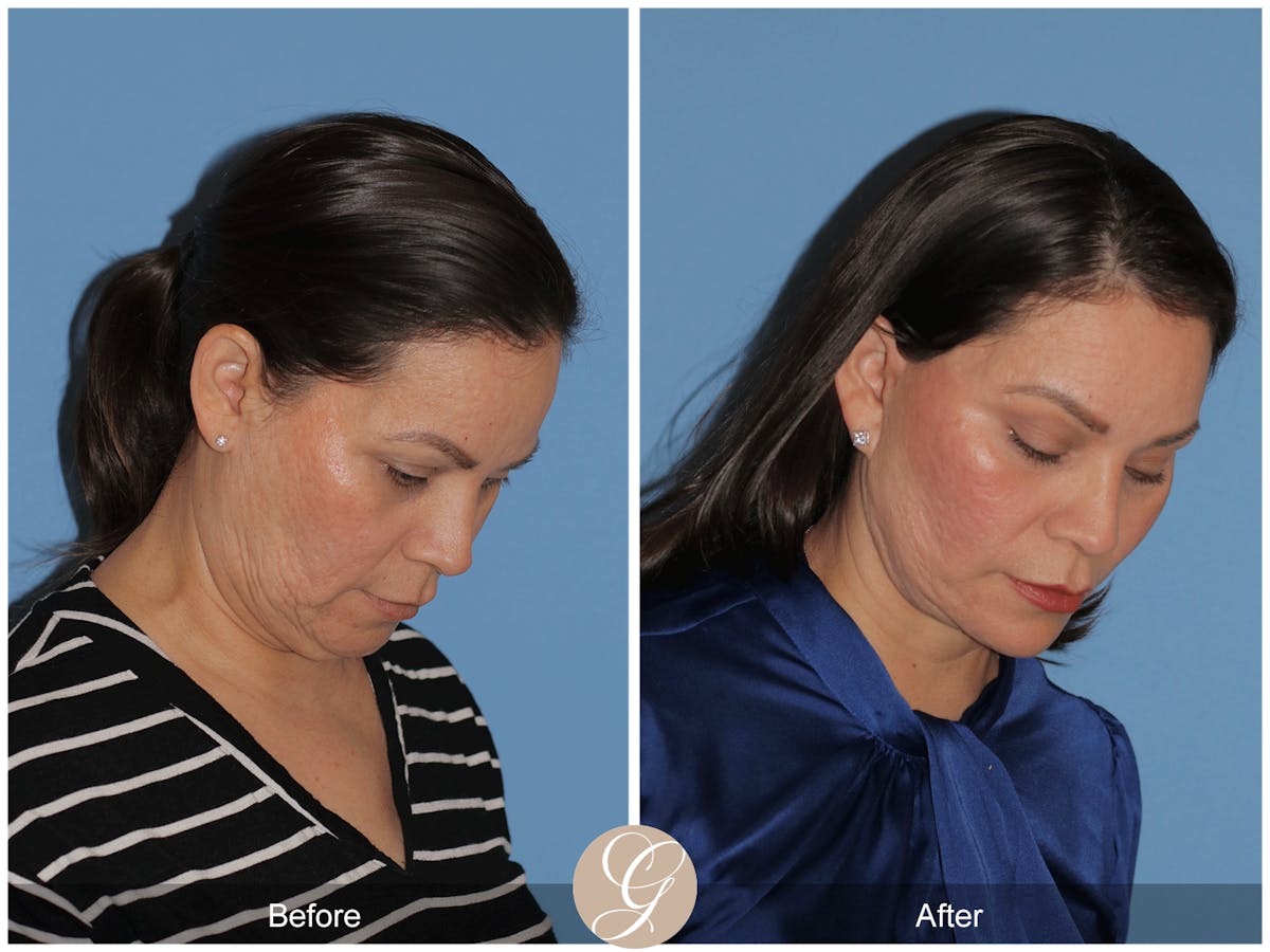 Preservation Facelift Before & After Gallery - Patient 156774 - Image 9