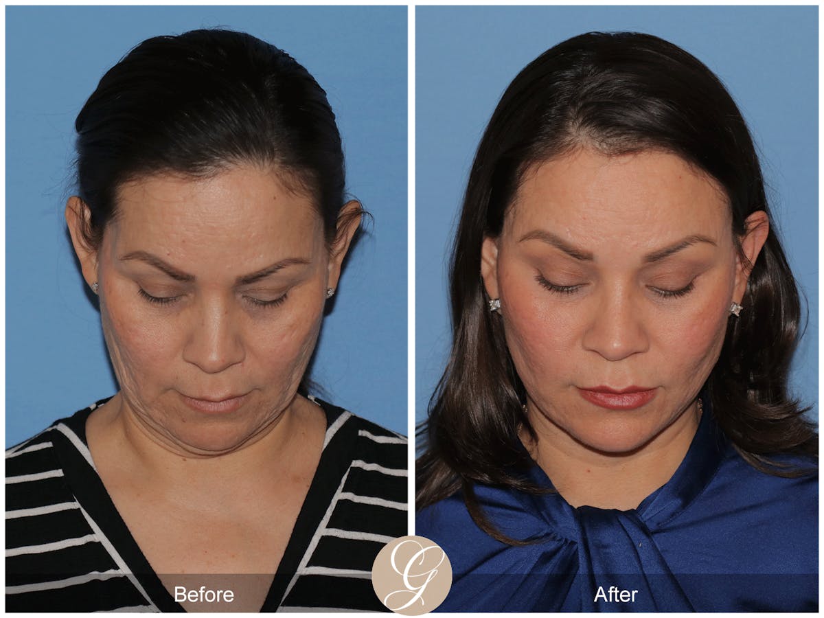 Preservation Facelift Before & After Gallery - Patient 156774 - Image 5