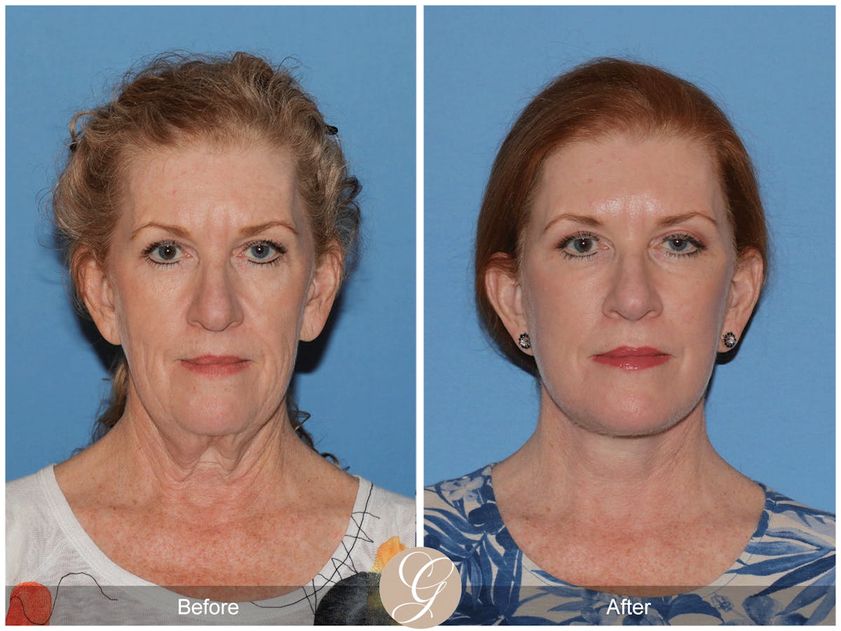 Preservation Facelift Before & After Gallery - Patient 259574 - Image 1