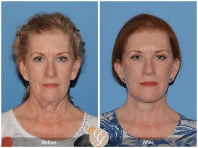 Deep Plane Facelift Before & After Gallery - Patient 312160 - Image 1