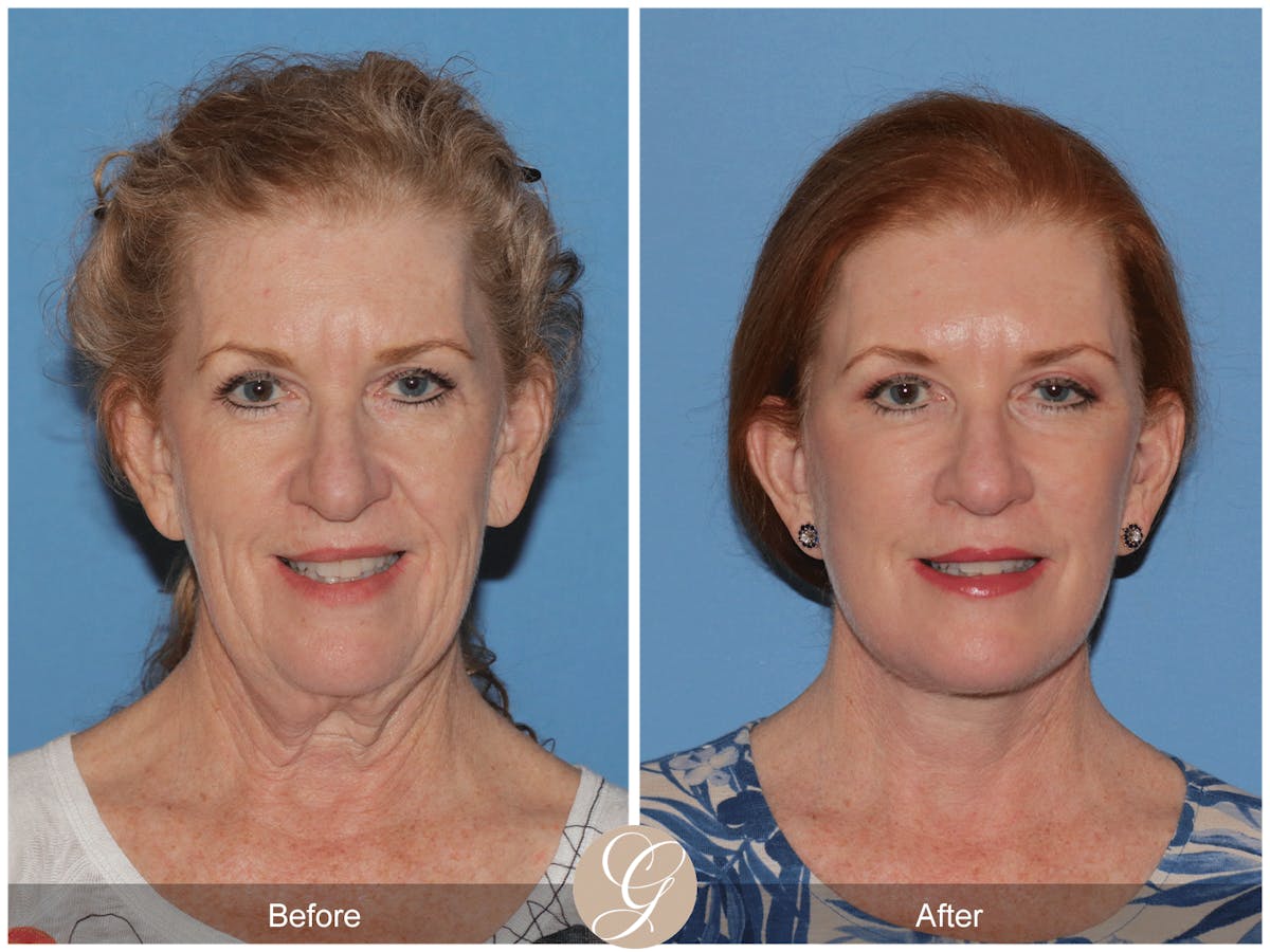 Preservation Facelift Before & After Gallery - Patient 259574 - Image 2