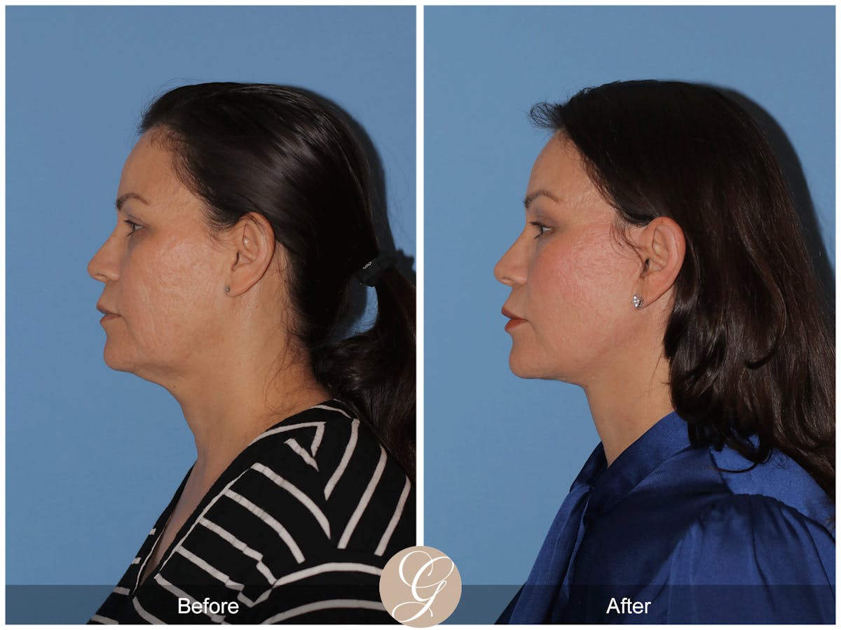 Preservation Facelift Before & After Gallery - Patient 156774 - Image 10