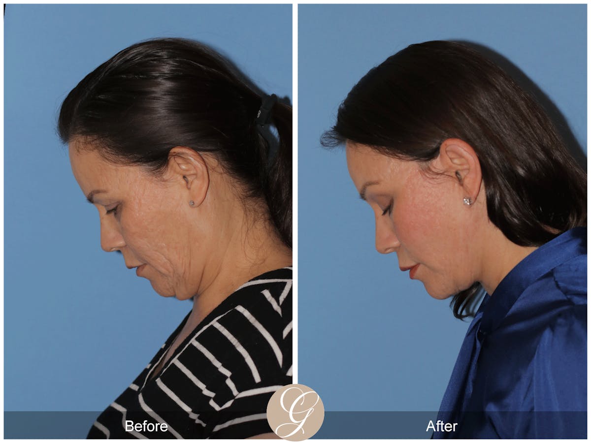 Preservation Facelift Before & After Gallery - Patient 156774 - Image 11