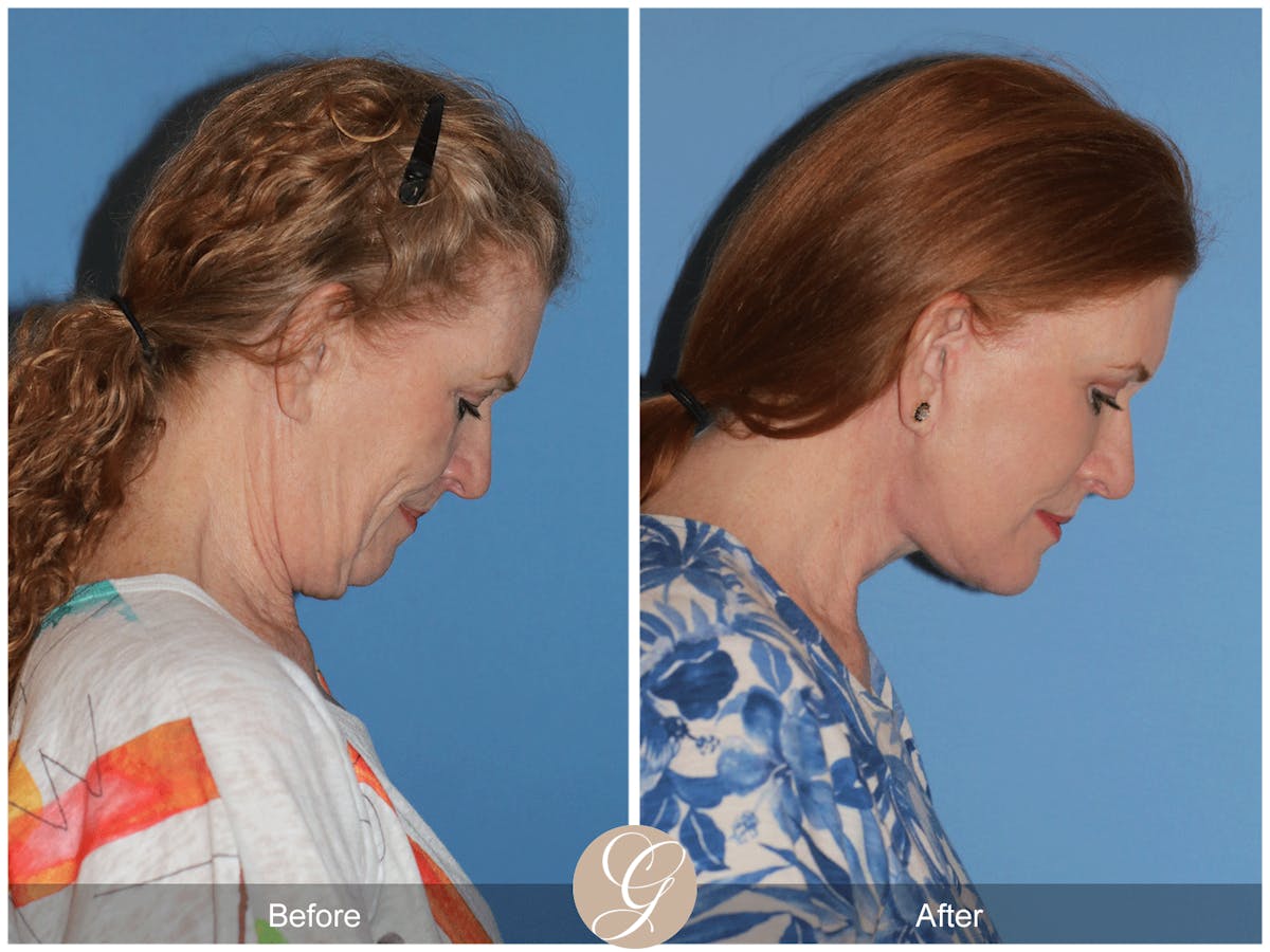 Preservation Facelift Before & After Gallery - Patient 259574 - Image 3
