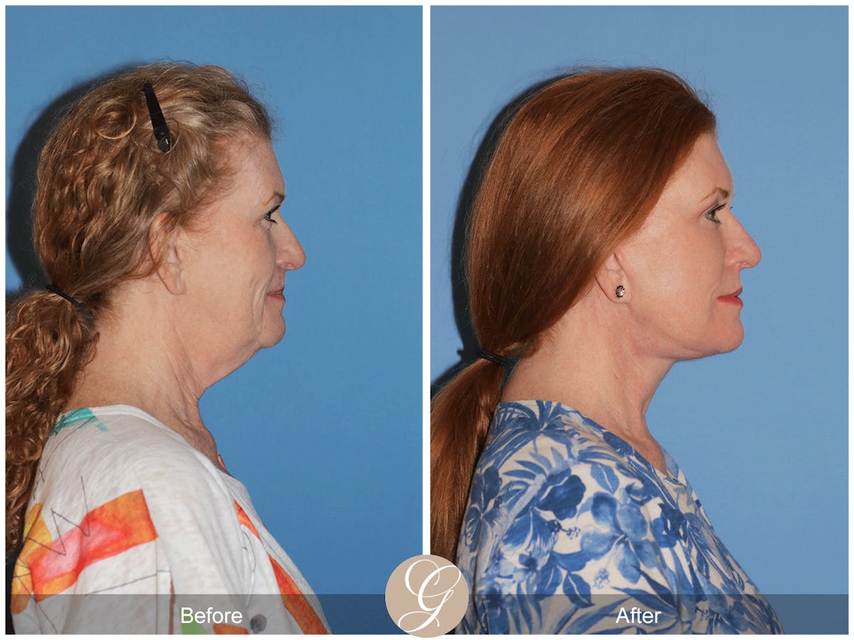 Preservation Facelift Before & After Gallery - Patient 259574 - Image 10