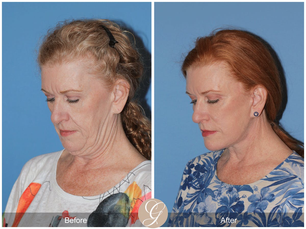 Preservation Facelift Before & After Gallery - Patient 259574 - Image 5