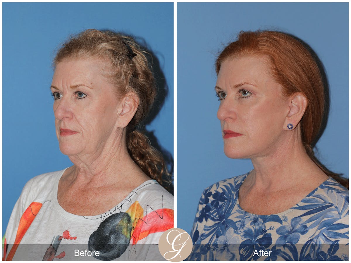 Preservation Facelift Before & After Gallery - Patient 259574 - Image 6