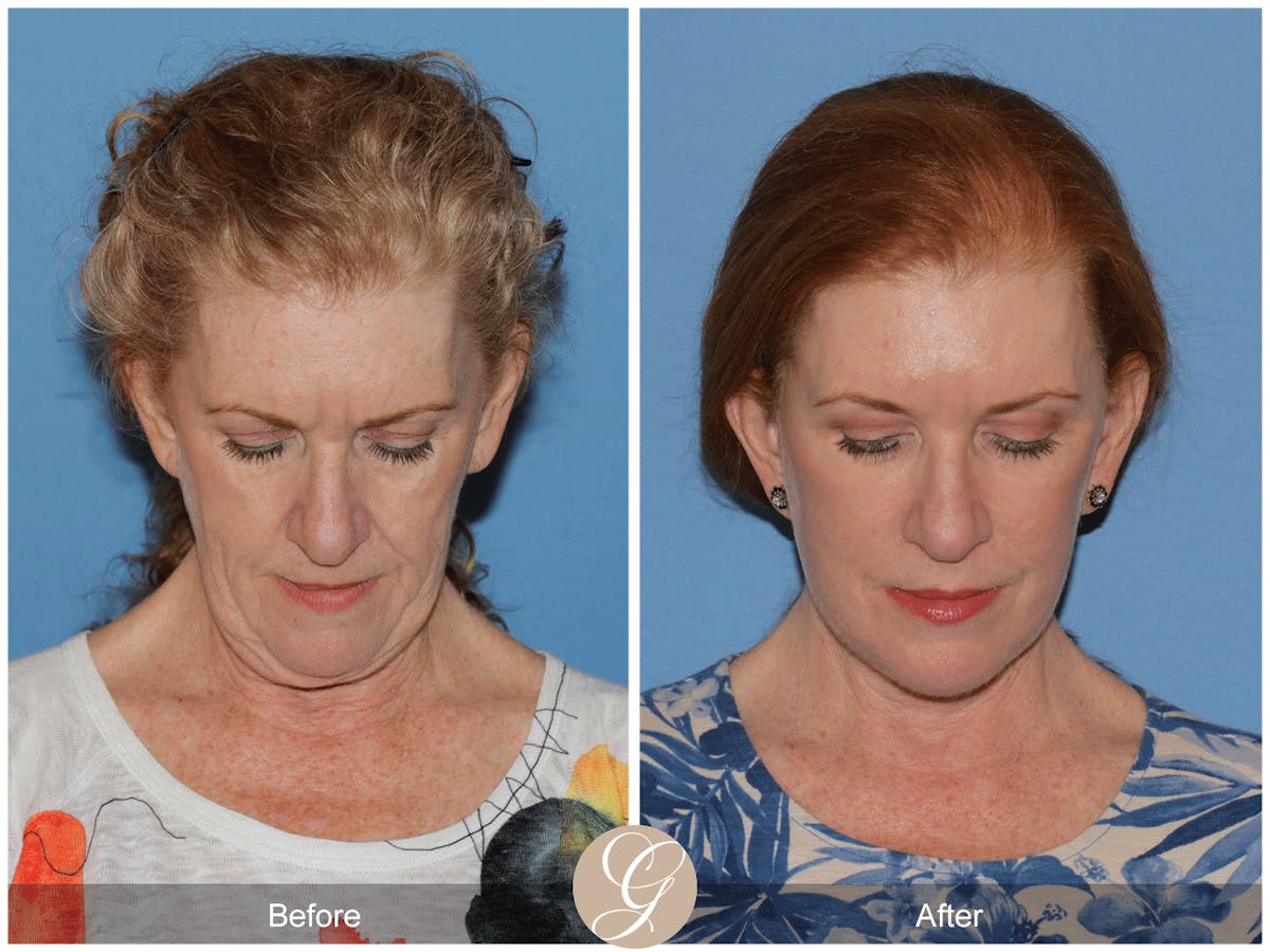 Preservation Facelift Before & After Gallery - Patient 259574 - Image 11