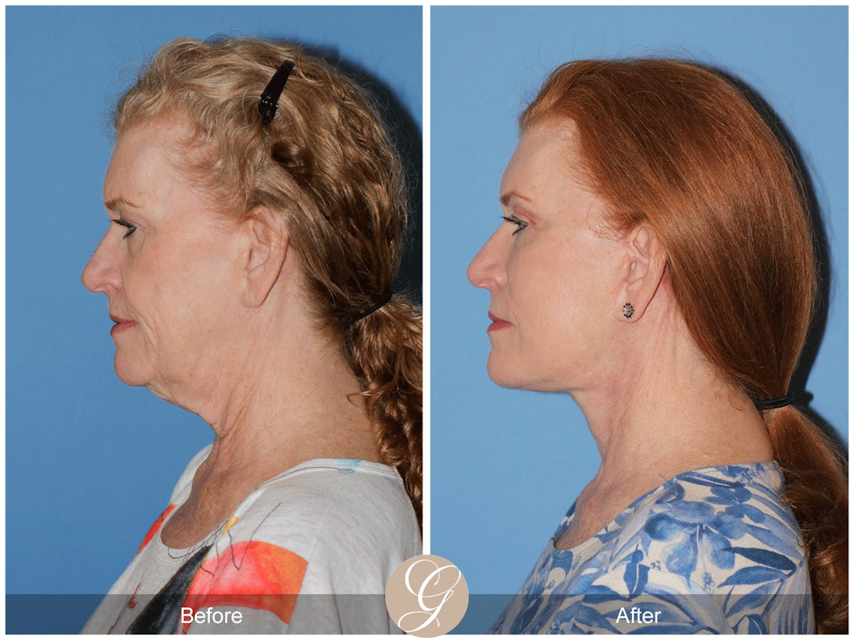 Preservation Facelift Before & After Gallery - Patient 259574 - Image 4