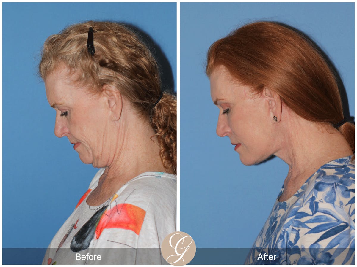 Preservation Facelift Before & After Gallery - Patient 259574 - Image 7