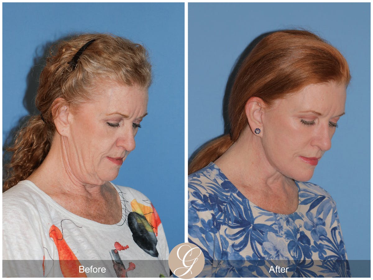 Preservation Facelift Before & After Gallery - Patient 259574 - Image 9