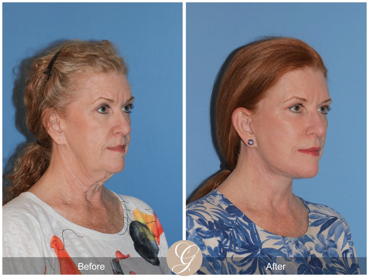 Preservation Facelift Before & After Gallery - Patient 259574 - Image 8