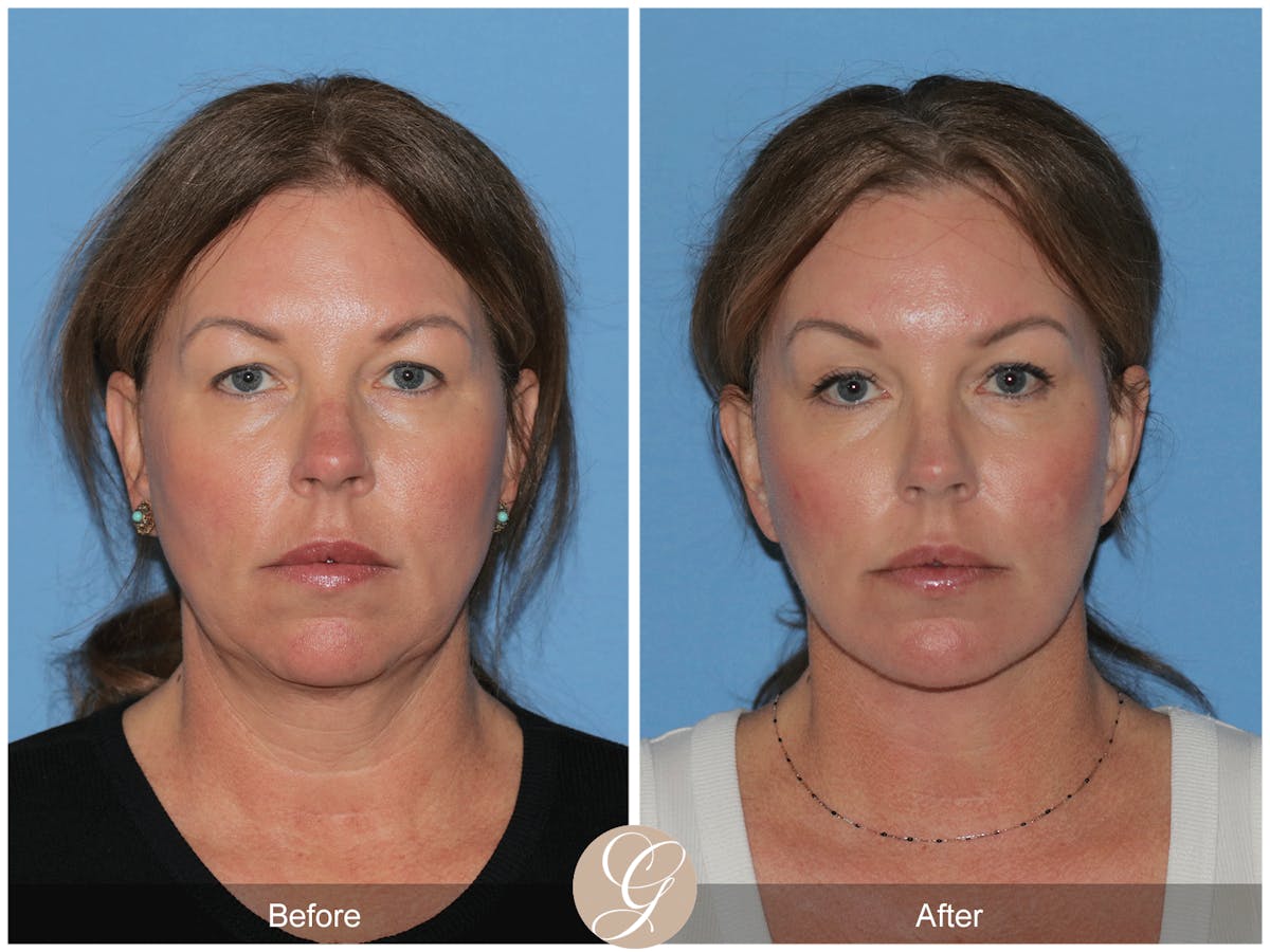 Preservation Facelift Before & After Gallery - Patient 285550 - Image 1