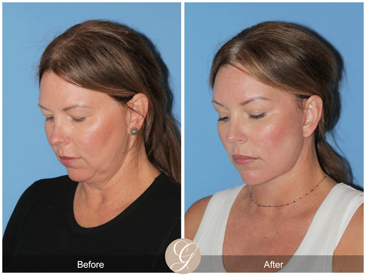 Preservation Facelift Before & After Gallery - Patient 285550 - Image 4