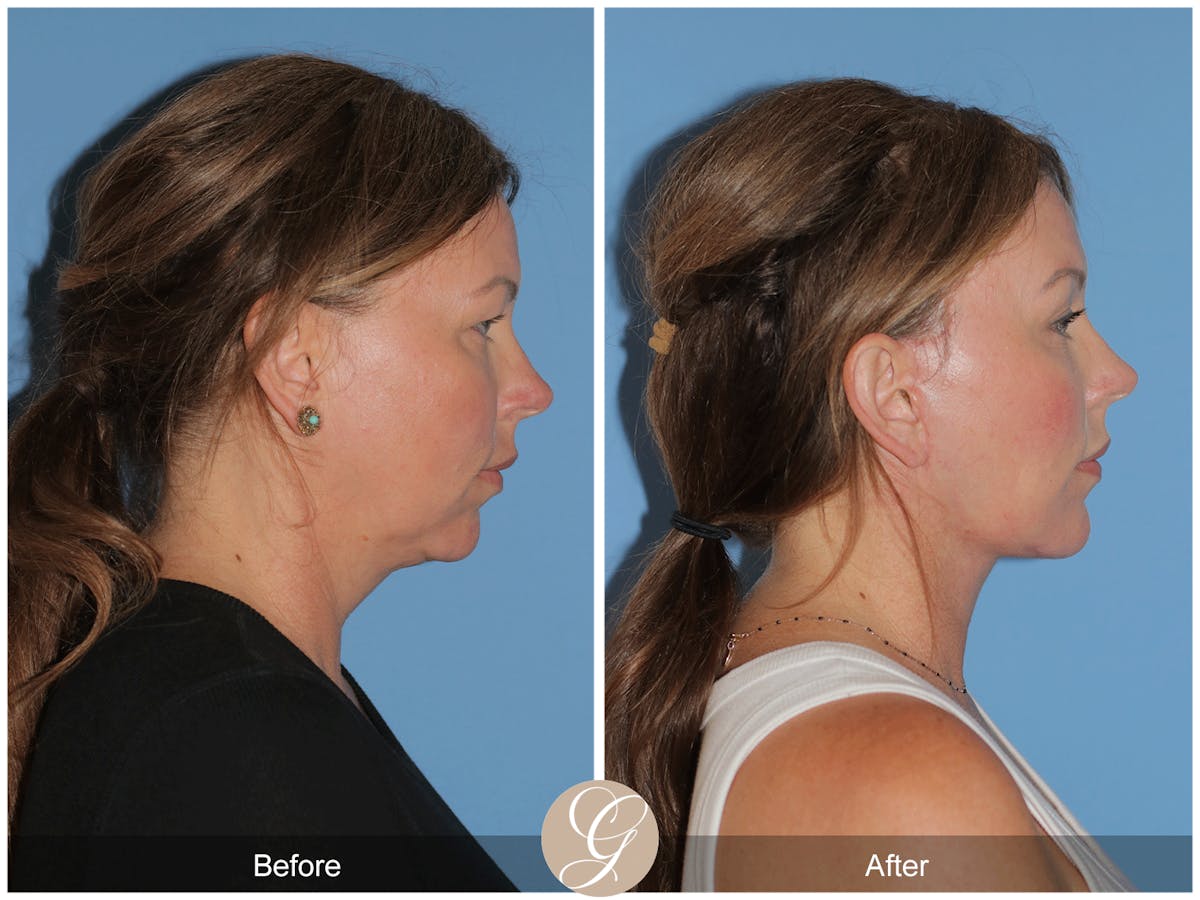 Preservation Facelift Before & After Gallery - Patient 285550 - Image 5