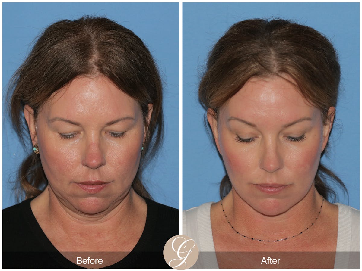 Preservation Facelift Before & After Gallery - Patient 285550 - Image 6