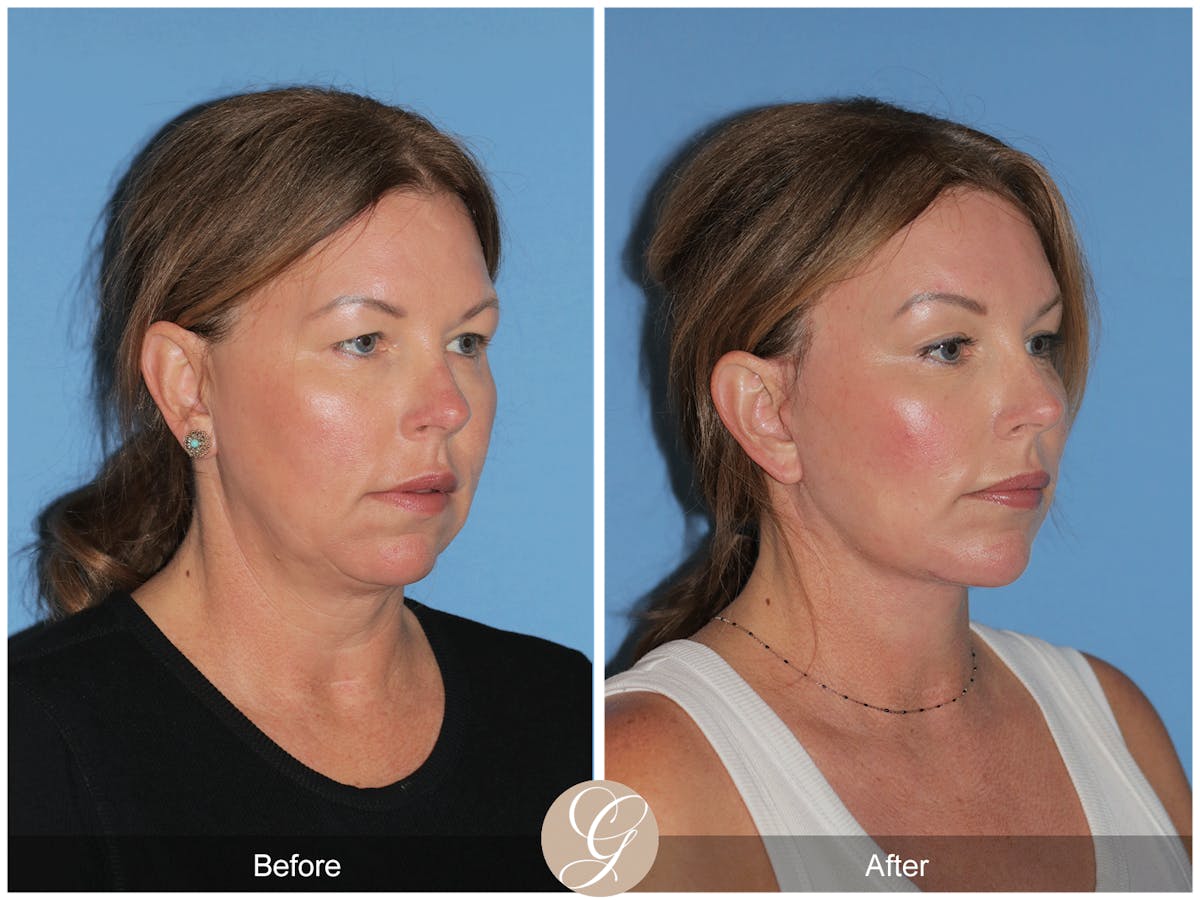 Preservation Facelift Before & After Gallery - Patient 285550 - Image 7