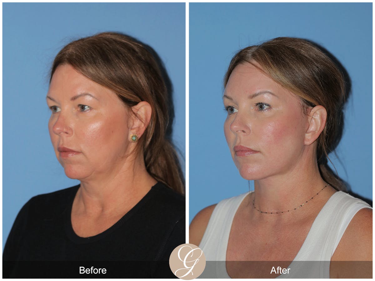 Preservation Facelift Before & After Gallery - Patient 285550 - Image 3