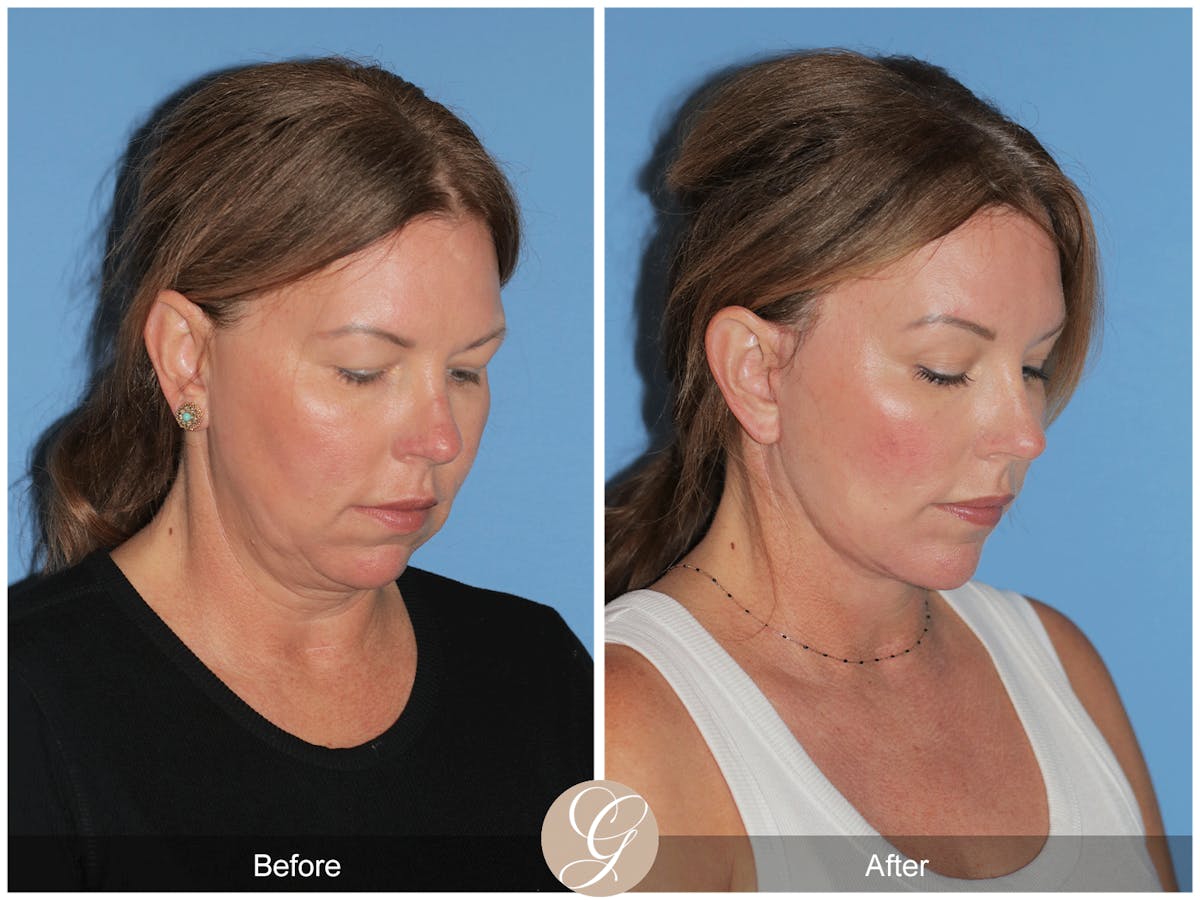 Preservation Facelift Before & After Gallery - Patient 285550 - Image 11