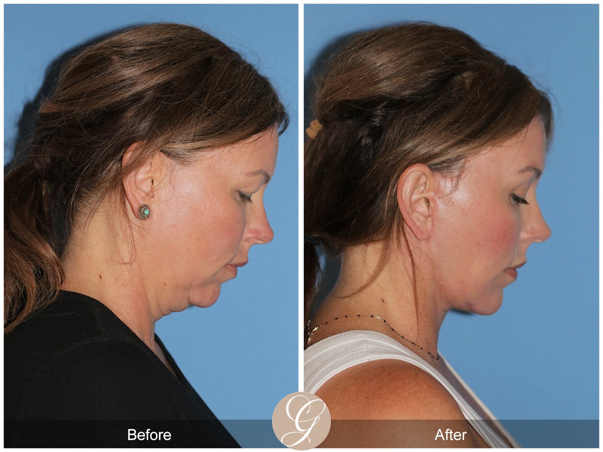 Preservation Facelift Before & After Gallery - Patient 285550 - Image 8