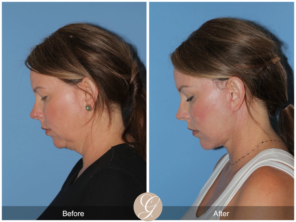 Preservation Facelift Before & After Gallery - Patient 285550 - Image 10