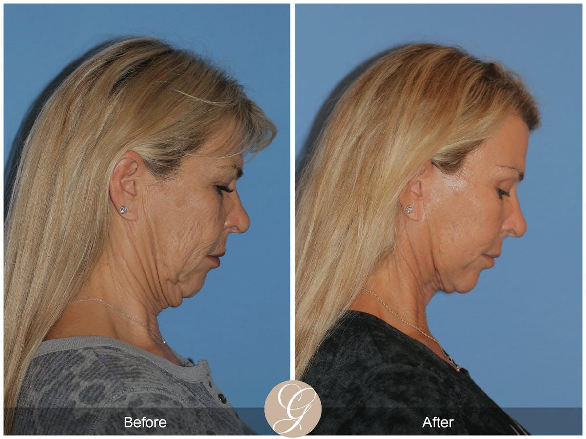 Deep Plane Facelift Before & After Gallery - Patient 221886 - Image 7