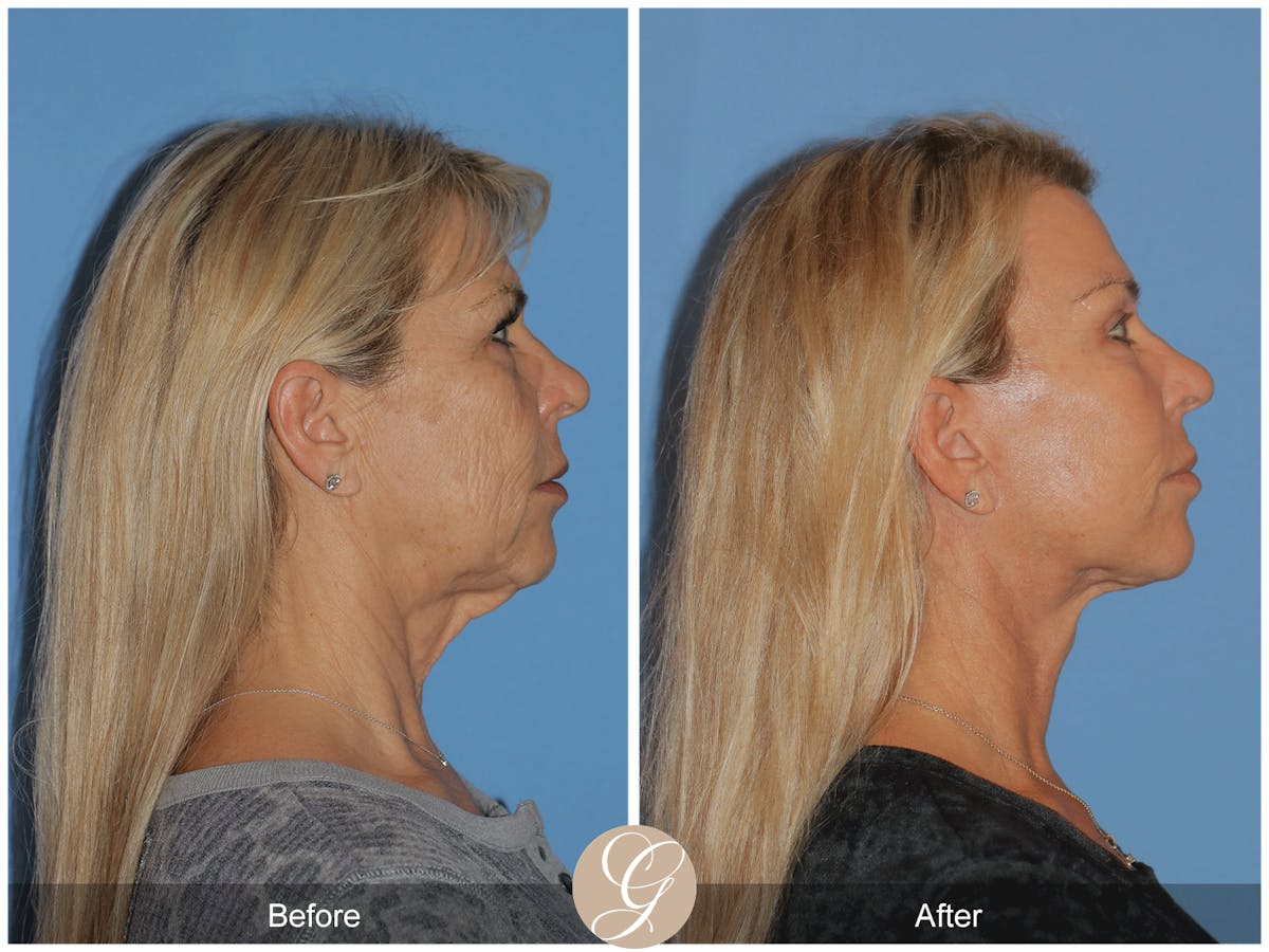 Deep Plane Facelift Before & After Gallery - Patient 221886 - Image 8