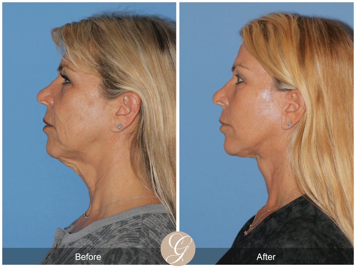Deep Plane Facelift Before & After Gallery - Patient 221886 - Image 10