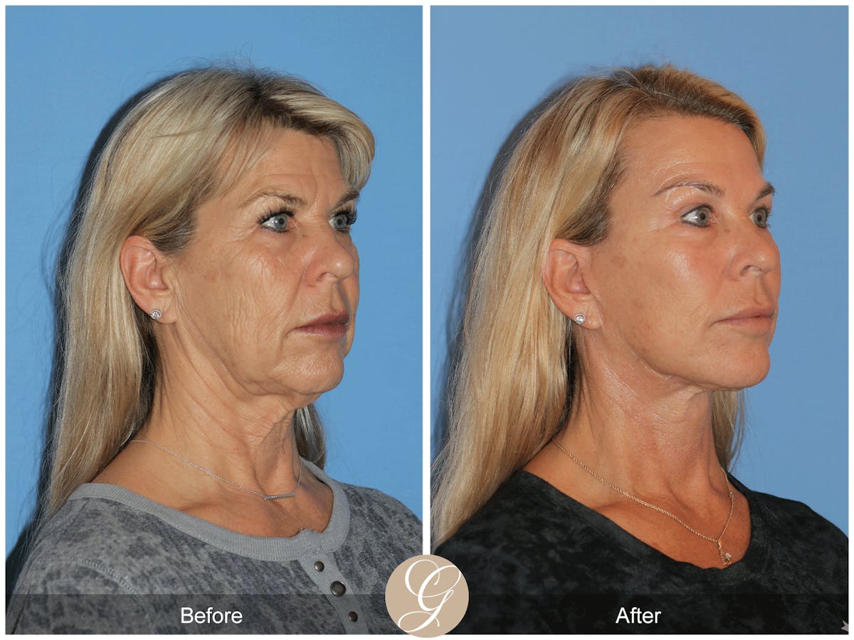 Deep Plane Facelift Before & After Gallery - Patient 221886 - Image 6