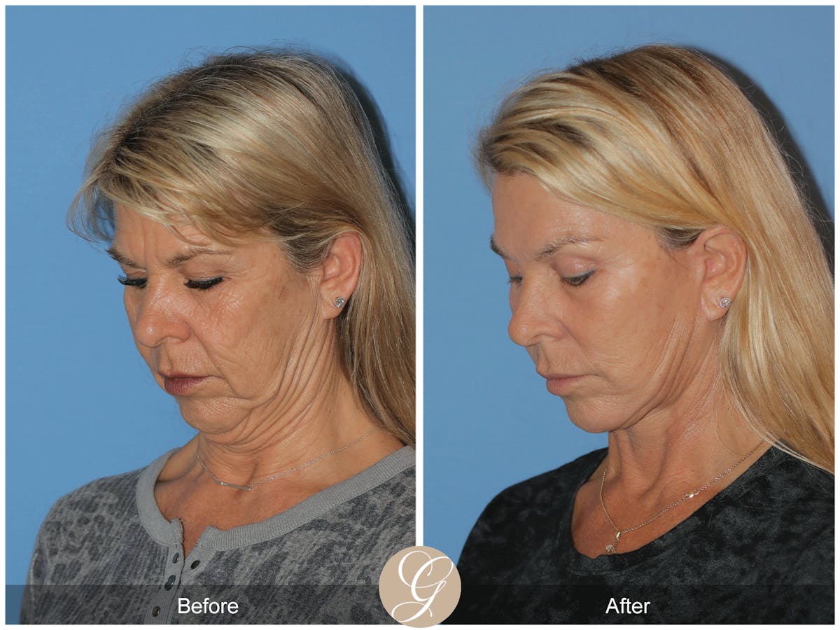 Deep Plane Facelift Before & After Gallery - Patient 221886 - Image 4