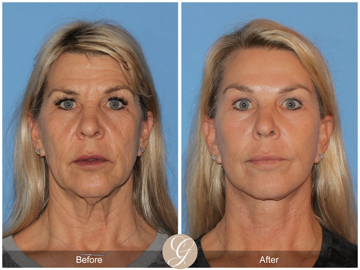 Deep Plane Facelift Before & After Gallery - Patient 221886 - Image 1