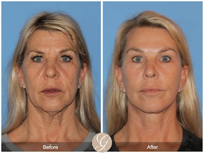 Deep Plane Facelift Before & After Gallery - Patient 221886 - Image 1