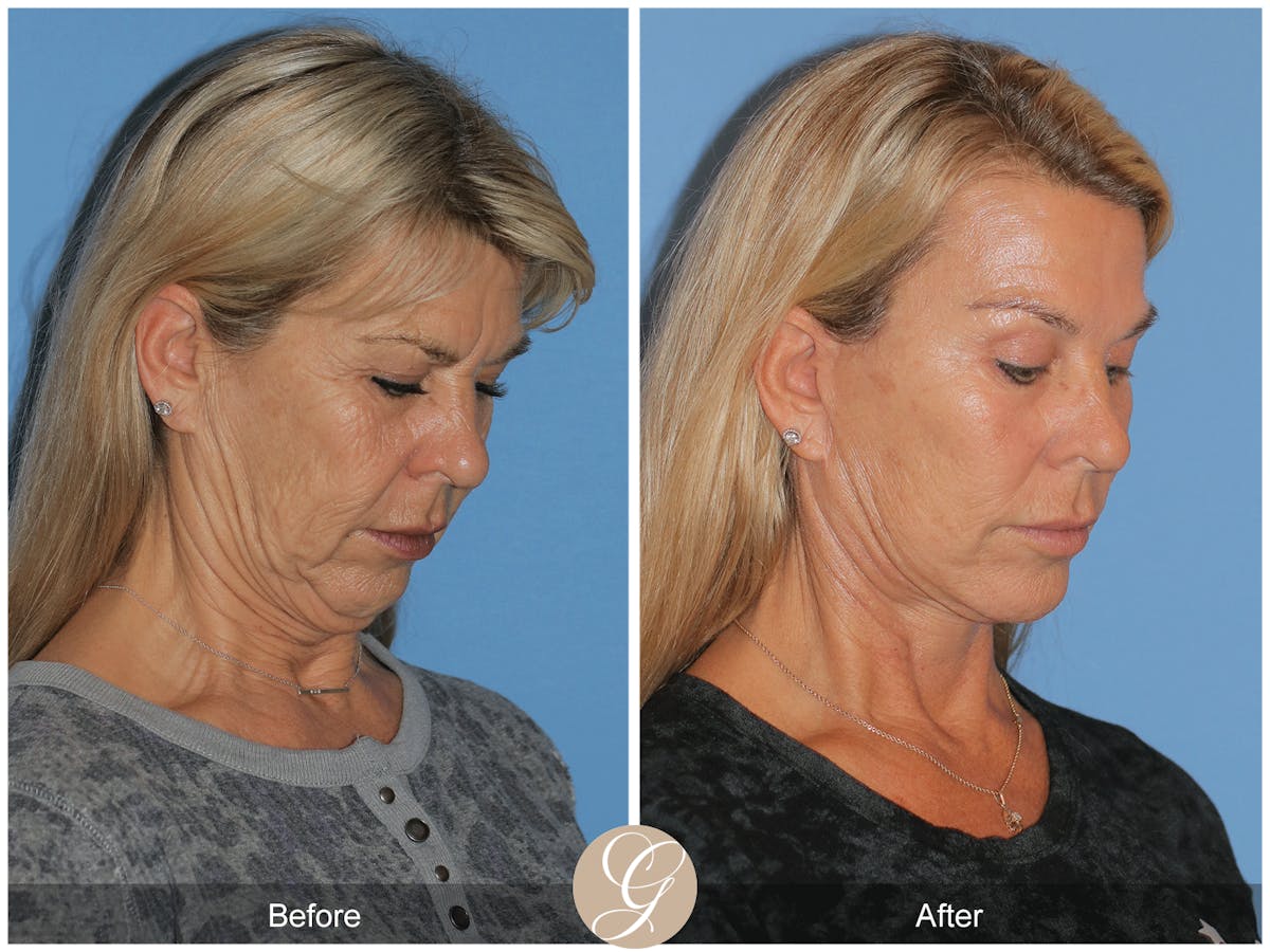 Deep Plane Facelift Before & After Gallery - Patient 221886 - Image 9