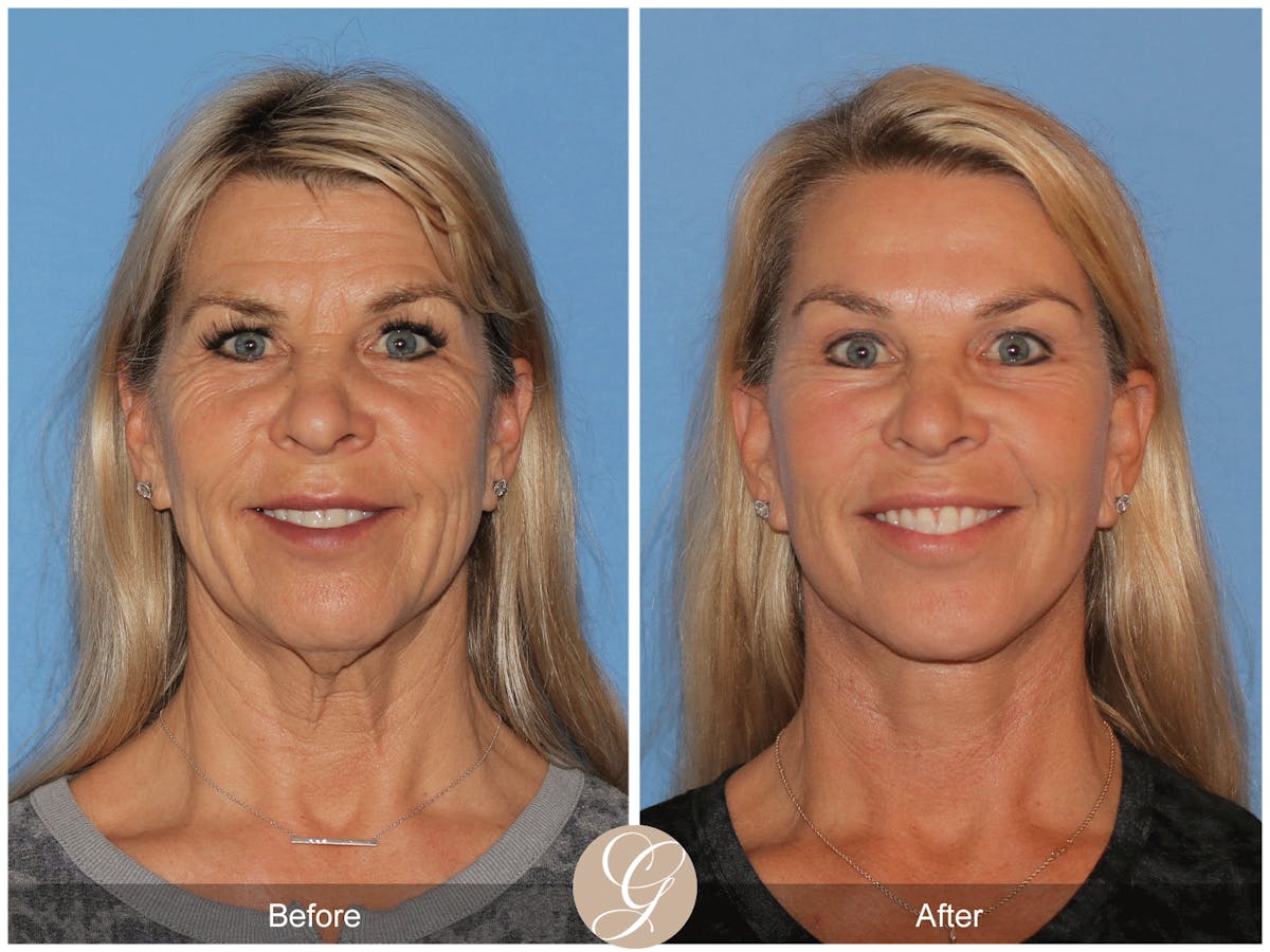 Deep Plane Facelift Before & After Gallery - Patient 221886 - Image 2