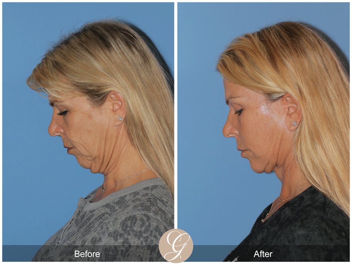 Deep Plane Facelift Before & After Gallery - Patient 221886 - Image 11